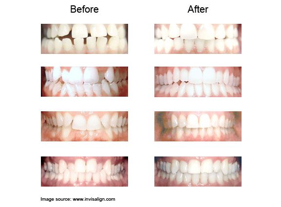 invisalign Before and After