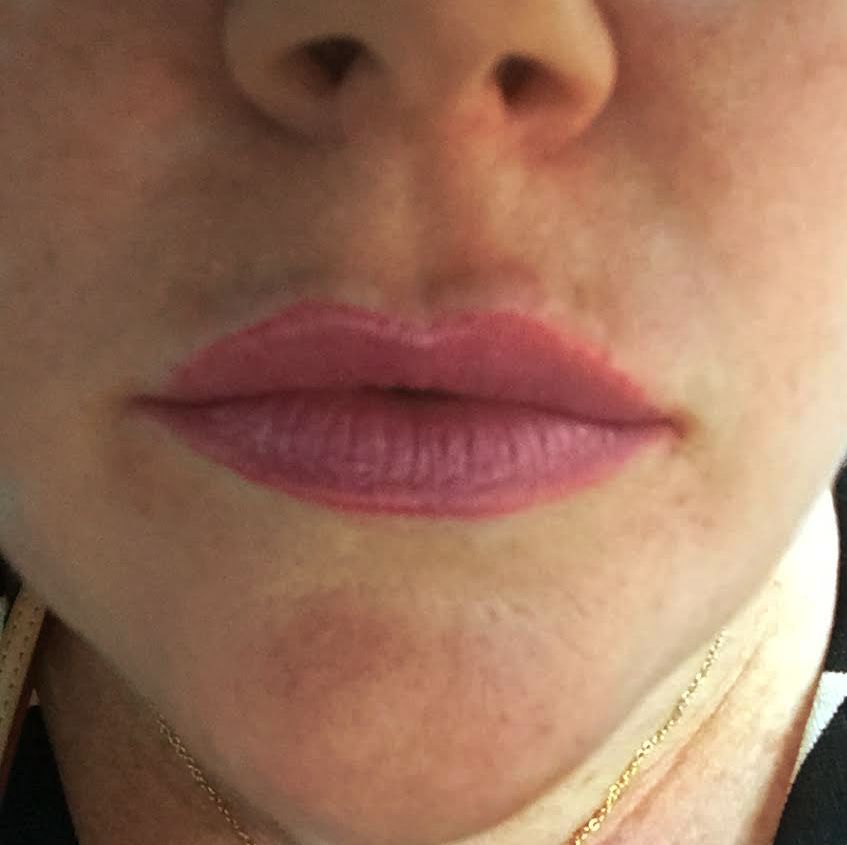 Restylane® Silk plumps lips