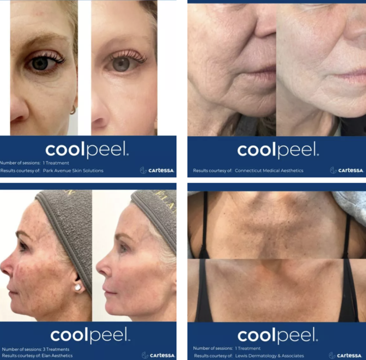 Pore Minimizing Serum Alternative-CoolPeel Skin Laser