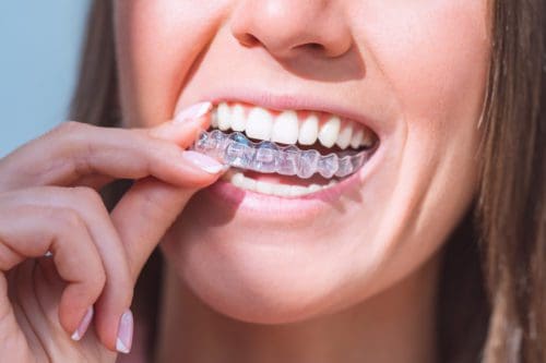 Debunking Common Myths About Invisalign Treatment