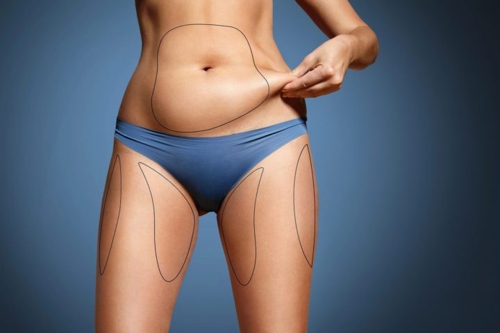 Does Ultrasonic Fat Cavitation Work?