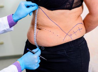 What is Mommy Makeover Plastic Surgery?